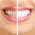 Воспаление дёсен и  лечение зубов в Люберцах