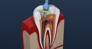 Причины для удаления корня зуба