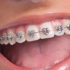 Вирівнювання зубів: сучасні методи та можливості