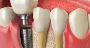 Имплантация зубов: современные технологии и возможности