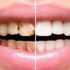 Как проходит реставрация зубов?