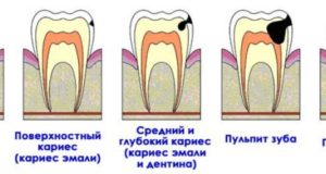 Кариес зубов: причины и симптомы