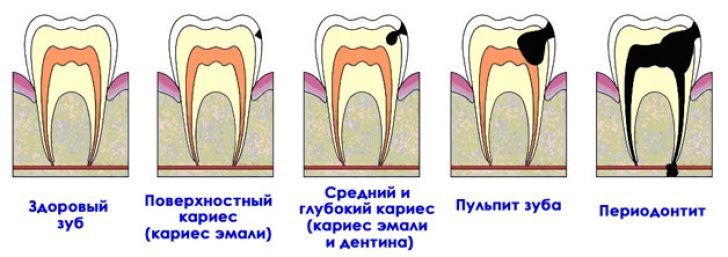 Кариес зубов: причины и симптомы